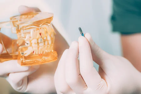 colocacion de implante dental